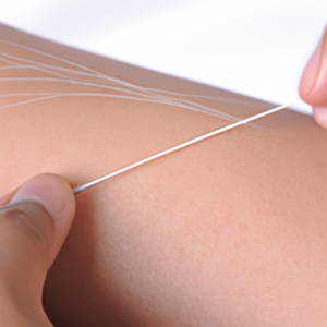 akupunktur uden nåle